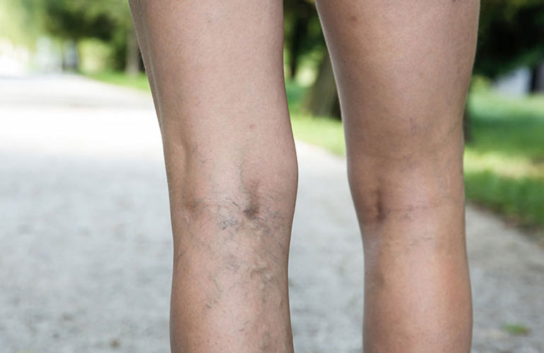 Causes Varicose Veins