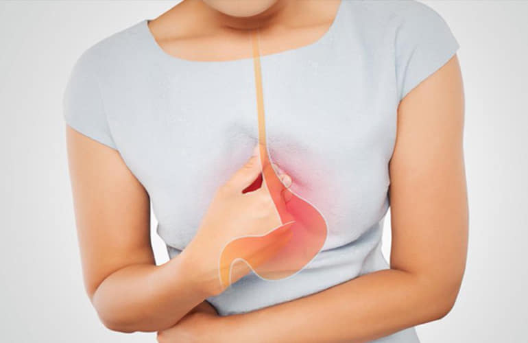 Gastroesophageal Reflux Disease