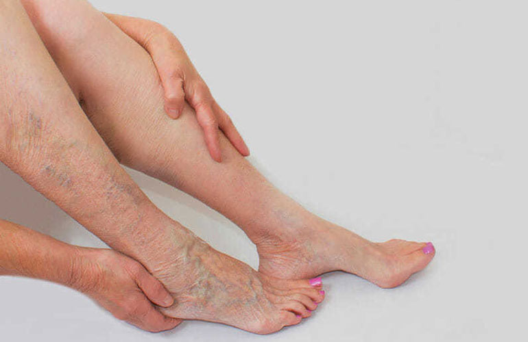 Varicose Veins In Legs